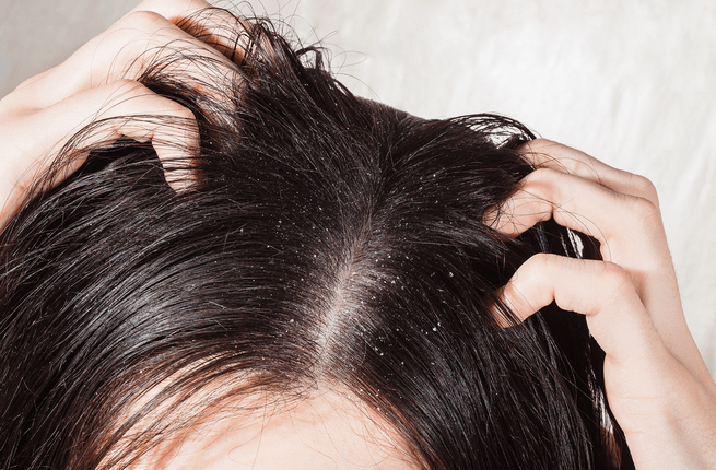 Itchy scalp